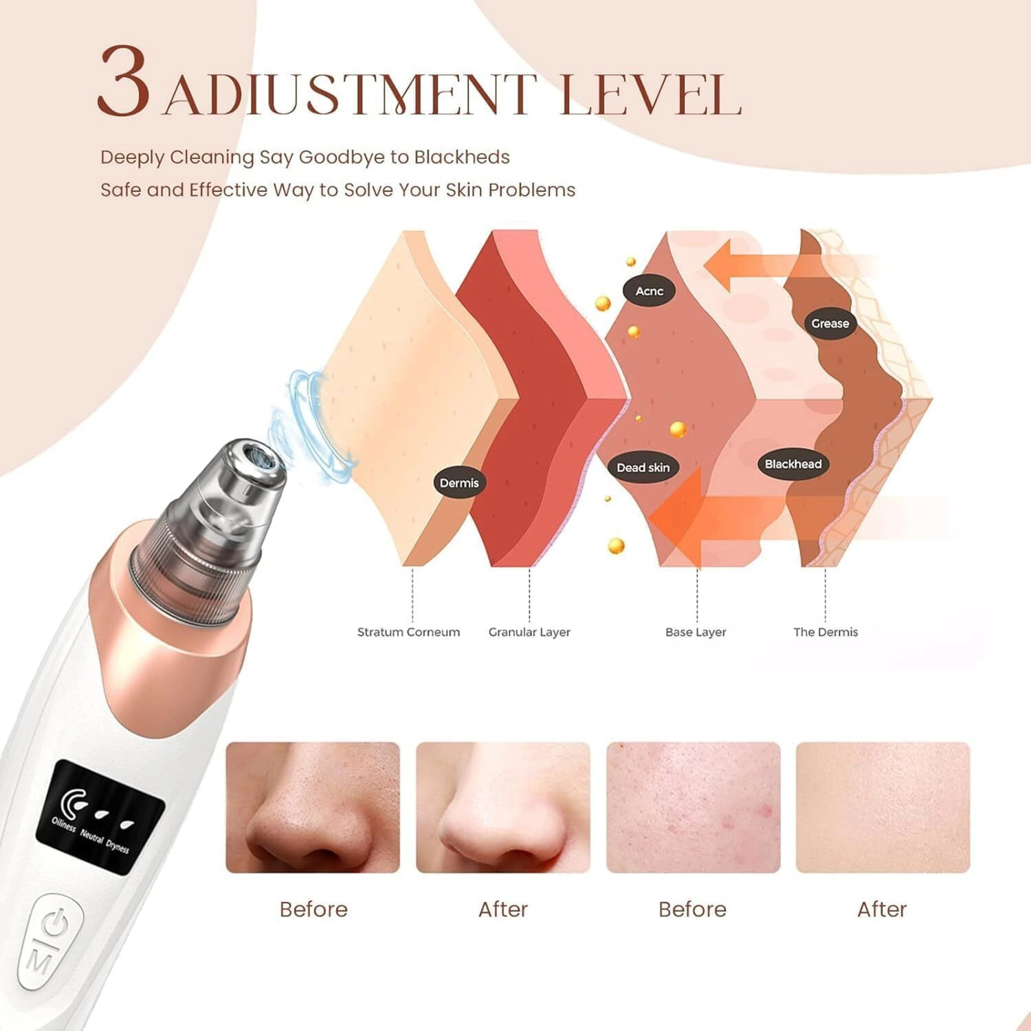 Image of Lumifrens Plastic Blackhead Remover Vacuum Suction Device (Pack of 5)