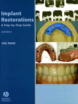 Implant Restorations 2 2nd  Edition(English, Hardcover, Drago Carl)