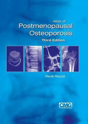 Atlas of Postmenopausal Osteoporosis(English, Paperback, unknown)