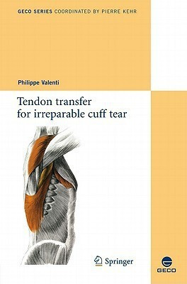 Tendon transfer for irreparable cuff tear(English, Paperback, unknown)