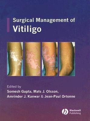 Surgical Management of Vitiligo(English, Hardcover, unknown)