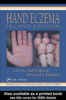 Hand Eczema(English, Electronic book text, unknown)