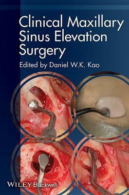 Clinical Maxillary Sinus Elevation Surgery(English, Electronic book text, unknown)