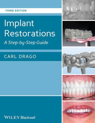 Implant Restorations(English, Electronic book text, Drago Carl)