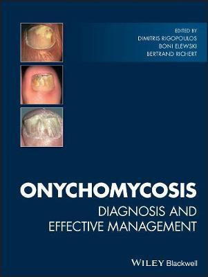 Onychomycosis(English, Electronic book text, unknown)