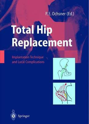Total Hip Replacement(English, Paperback, unknown)