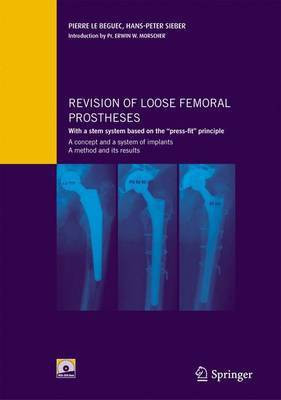 Revision of Loose Femoral Prostheses(English, Electronic book text, Le Beguec, Pierre Hans-Peter)