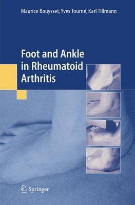 Foot and Ankle in Rheumatoid Arthritis(English, Paperback, Bouysset M.)