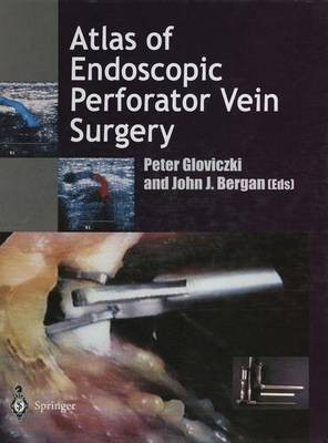 Atlas of Endoscopic Perforator Vein Surgery(English, Paperback, unknown)