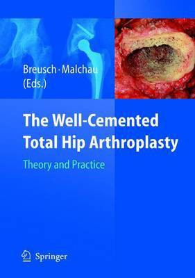 The Well-Cemented Total Hip Arthroplasty(English, Hardcover, unknown)