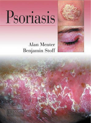 Psoriasis(English, Electronic book text, Menter Alan)