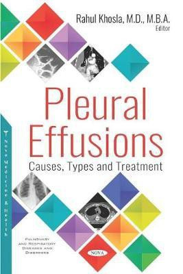 Pleural Effusions(English, Hardcover, unknown)