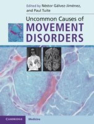 Uncommon Causes of Movement Disorders(English, Hardcover, unknown)