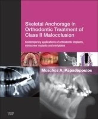 Skeletal Anchorage in Orthodontic Treatment of Class II Malocclusion  - Contemporary Applications of Orthodontic Implants, Miniscrew Implants and Miniplates(English, Hardcover, unknown)