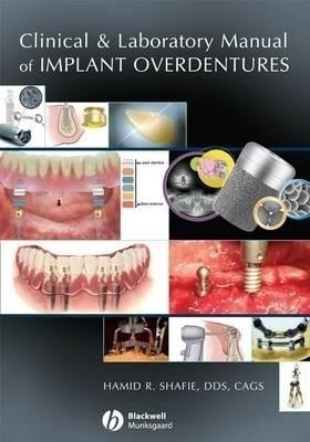 Clinical and Laboratory Manual of Implant Overdentures(English, Hardcover, Shafie Hamid R.)