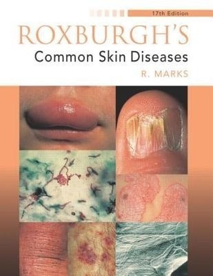 Roxburgh's Common Skin Diseases, 17Ed(English, Paperback, Marks Ronald)