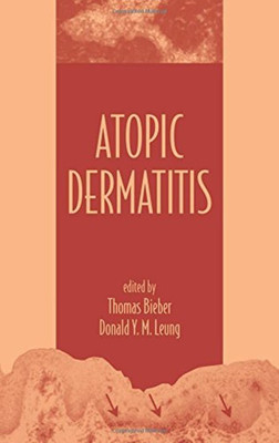 Atopic Dermatitis(English, Hardcover, unknown)