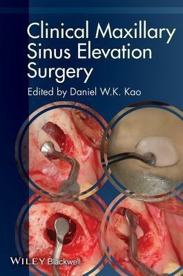 Clinical Maxillary Sinus Elevation Surgery(English, Paperback, unknown)