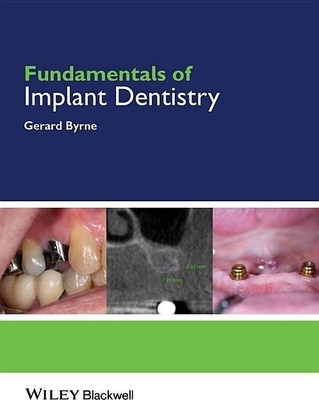 Fundamentals of Implant Dentistry(English, Paperback, Byrne Gerard)
