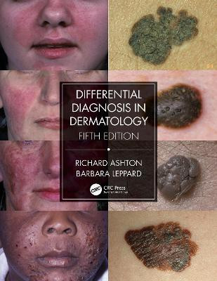 Differential Diagnosis in Dermatology(English, Paperback, Ashton Richard)