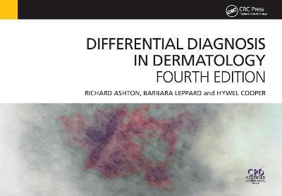Differential Diagnosis in Dermatology(English, Paperback, Ashton Richard)