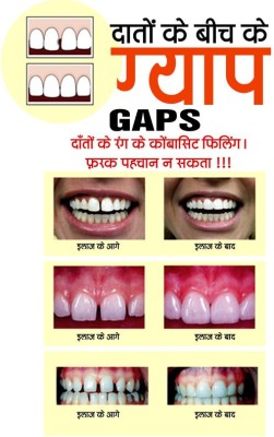 Poster Dental Doctor Gaps In Teeth (Hindi Poster) Large Poster (36 X 24 Inch, Multicolour) Fine Art Print(24 inch X 36 inch, Rolled)