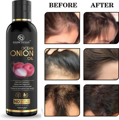 glowocean Onion oil For Hair Fall Control, Hair Growth & Hair Regrowth-Control Dandruff Hair Oil(100 ml)