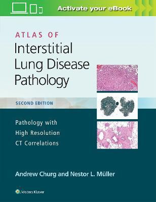 Atlas of Interstitial Lung Disease Pathology  - ATLAS OF INTERSTITIAL LUNG DISEASE PATHOLOGY PATHOLOGY WITH HIGH RESOLUTION CT CORRELATIONS 2ED (HB 2020)(English, Hardcover, Churg Andrew)