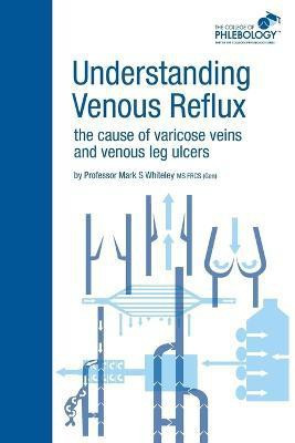Understanding Venous Reflux the Cause of Varicose Veins and Venous Leg Ulcers(English, Paperback, Whiteley Mark S.)