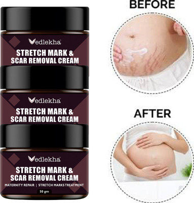 Vedlekha Stretch Marks Cream for Reducing Stretch Marks-50gm-3-Jar-(150 g)