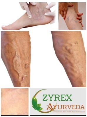 ZYREX Varicose Veins Cure Powder-200gm Pack.