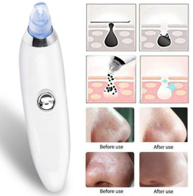 Glamezone Plastic Blackhead Remover Vacuum Suction Device(Pack of 1)