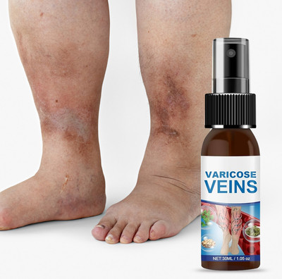 house of common Instant Relief Varicose Vein Spray – Soothes Aching & Swollen Legs Spray(30 ml)