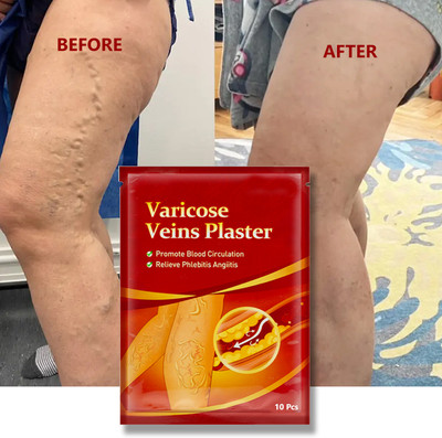 BEUTISKY VeinEase Patches – Anti-Swelling Plaster for Varicose Vein Discomfort & Healing Plaster & Patch(10 x 10 g)