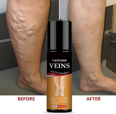 SQUERA Herbal Spray for Legs | Relief from Swelling, Varicose & Spider Veins Spray(50 ml)