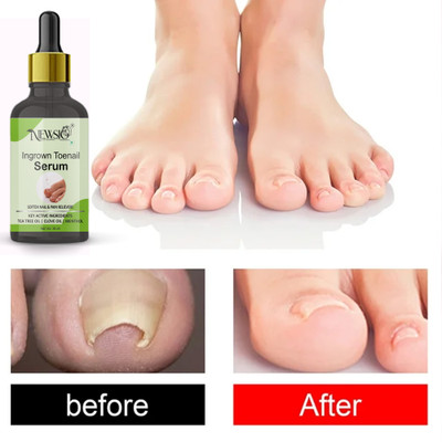 Newsio Ingrown Toenail Serum Boost Nail Strong & Repair Nails Serum.(30 ml)