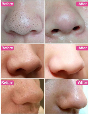 ADJD Skin Care Cleansing Nose Strips,Blackheads Removal Nose Patch Peel(10 g)