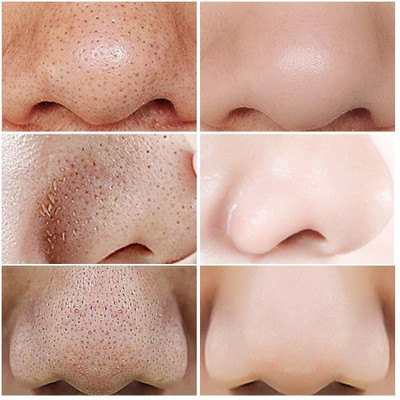 DARVING Blackhead Remover Deep Cleansing Nose Pore Strips for MEN & WOMEN 10 Strips(10 g)