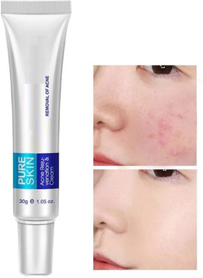 EVERERIN Acne Pimple Scar Cream, Anti-inflammatory | Acne, Pimples, Whiteheads And Blackheads Removing(30 g)