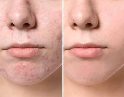 GFSU - GO FOR SOMETHING UNIQUE Pimple Spot Scar Blackhead Oil Control Moisturizer Skin Care(30 g)