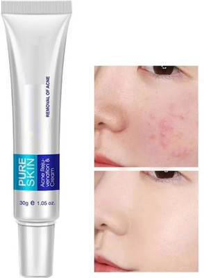 GFSU - GO FOR SOMETHING UNIQUE Pimple Marks, Acne Scar, Pigmentation Blemish Removal for all skin type(30 g)
