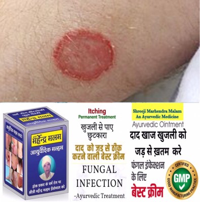 Shreeji Marhendra Ayurvedic Anti fungal Malam - for Ringworm, itching, Eczema & Skin Tretment~(25 g)