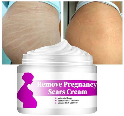 MYEONG Stretch Marks Removal Cream(50 g)
