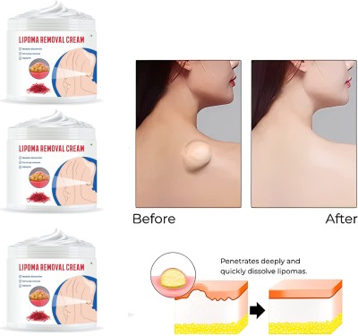 ONEAL Lipoma Removal Cream Lump Remover Neck fat shoulder fat body fat (3 Pcs)(150 g)