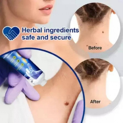 kHUDAt hik Warts Remover Cream Extract Corn Treatment Ointment Painless(BANGLORE)(20 ml)