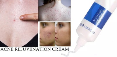 GFSU - GO FOR SOMETHING UNIQUE ACNE REJUVENATION CREAM(30 g)