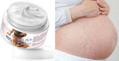 ADJD Vitamin c Stretch Marks and Scar Removal Cream(50 g)