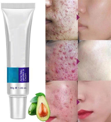 GFSU - GO FOR SOMETHING UNIQUE Pimple Marks, Acne Scar, Pigmentation Blemish Removal(30 g)