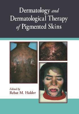 Dermatology and Dermatological Therapy of Pigmented Skins(English, Hardcover, unknown)