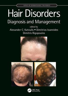 Hair Disorders(English, Electronic book text, unknown)